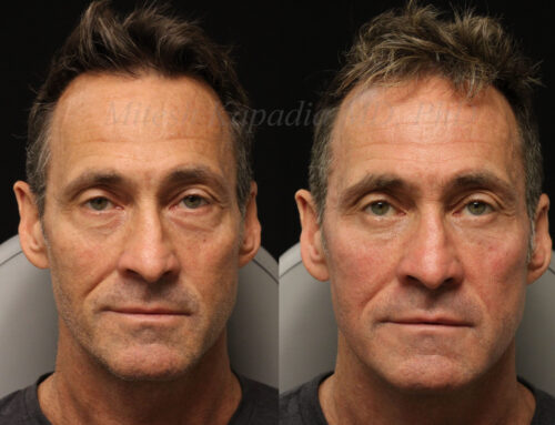Before and 6 months after lower blepharoplasty surgery