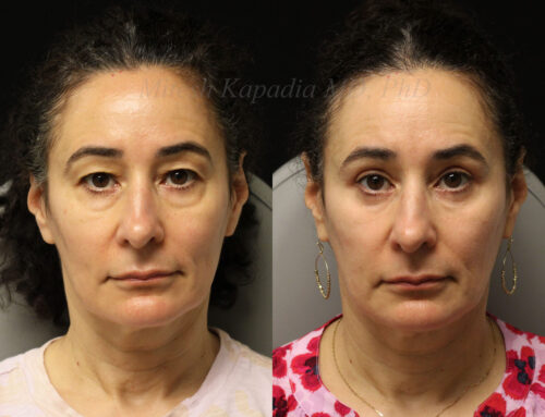 Before and 6 months after upper and lower blepharoplasty surgery with lower lid CO2 laser resurfacing