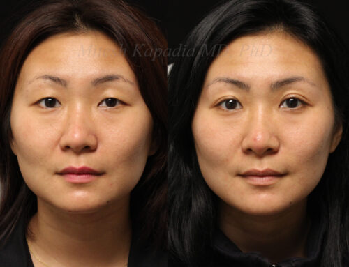 Before and 6 months after upper blepharoplasty surgery with upper lid crease formation