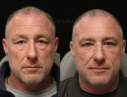 Before and 6 months after upper and lower blepharoplasty surgery with lower lid CO2 laser resurfacing