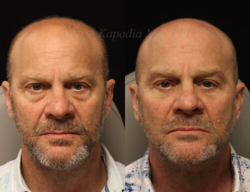 Before and 6 months after lower blepharoplasty surgery