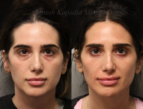 Before and 7 months after lower blepharoplasty surgery with lower lid CO2 laser resurfacing