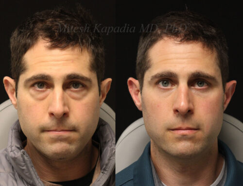 Before and 6 months after lower blepharoplasty surgery