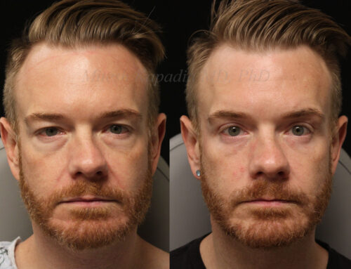 Before and 6 months after upper and lower blepharoplasty surgery with lower lid CO2 laser resurfacing