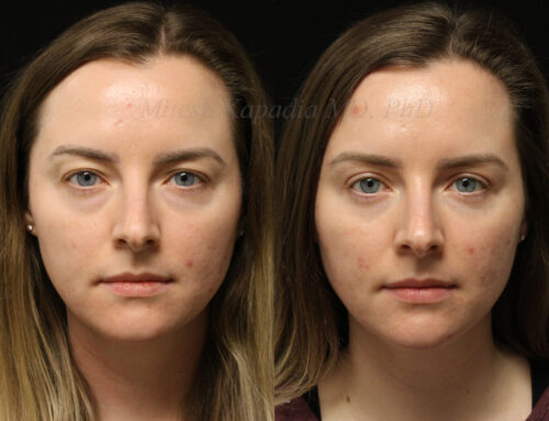 Before and 6 months after upper and lower blepharoplasty surgery