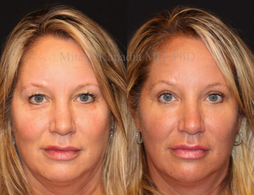 Before and 6 months after upper blepharoplasty surgery