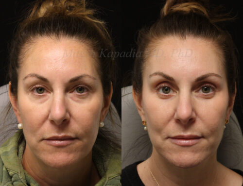 Before and 6 months after lower blepharoplasty surgery with lower lid CO2 laser resurfacing
