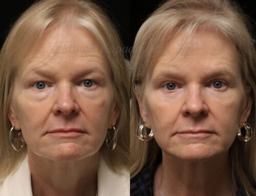 Before and 10 months after upper and lower blepharoplasty surgery with lower lid CO2 laser resurfacing