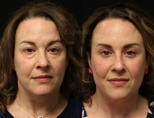Before and 6 months after upper and lower blepharoplasty surgery with lower lid CO2 laser resurfacing