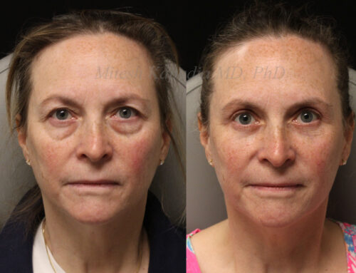 Before and 6 months after upper and lower blepharoplasty surgery with lower lid CO2 laser resurfacing