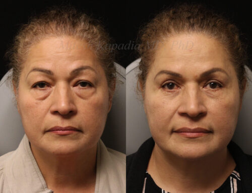 Before and 8 months after upper and lower blepharoplasty surgery with canthopexy