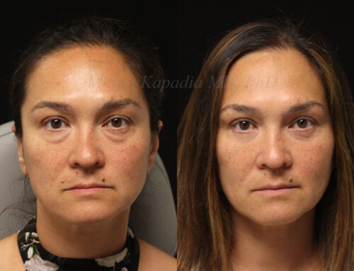 Before and 11 months after lower blepharoplasty surgery