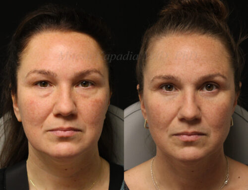 Before and 7 months after upper and lower blepharoplasty surgery with lower lid CO2 laser resurfacing