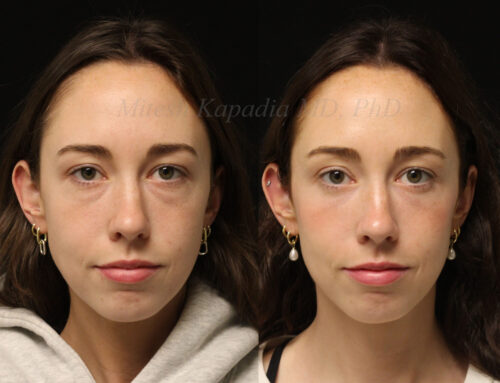 Before and 6 months after lower blepharoplasty surgery with lower lid CO2 laser resurfacing