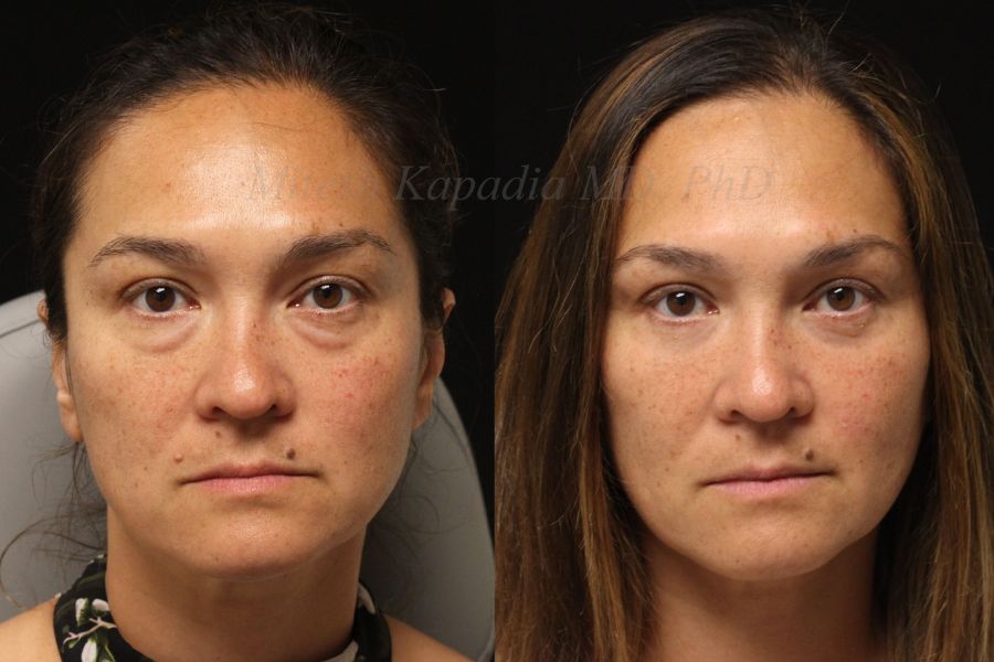 Droopy Eyelids & Aging: How Surgery Can Refresh Your Look blog image
