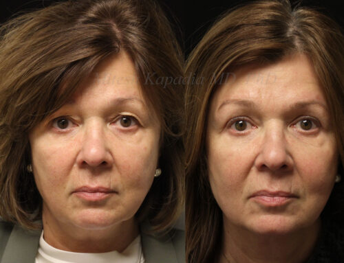 Before and 6 months after upper eyelid blepharoplasty surgery