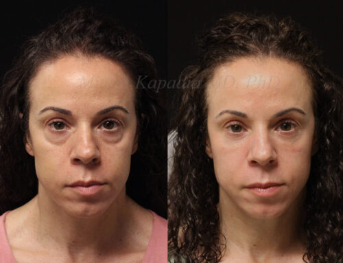 Before and 8 months after lower blepharoplasty surgery