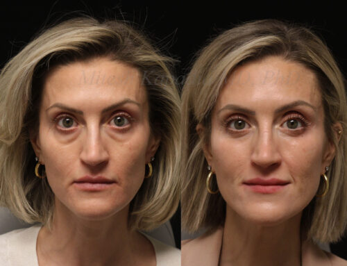 Before and 7 months after lower lid blepharoplasty surgery with lower lid CO2 laser resurfacing