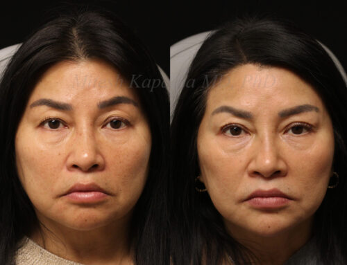 Before and 8 months after upper blepharoplasty surgery with lid crease formation