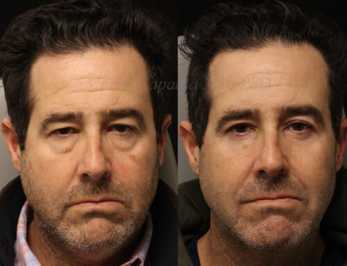 Before and 6 months after upper and lower blepharoplasty surgery with lower lid CO2 laser resurfacing