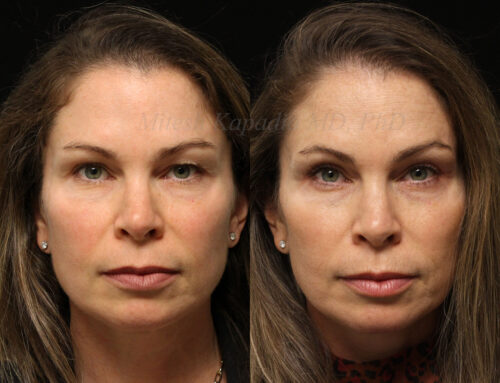 Before and 6 months after upper blepharoplasty surgery