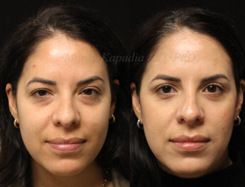 Before and 6 months after upper and lower blepharoplasty surgery