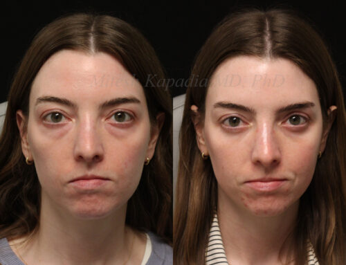Before and 6 months after lower blepharoplasty surgery