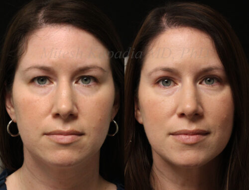 Before and 6 months after upper blepharoplasty surgery
