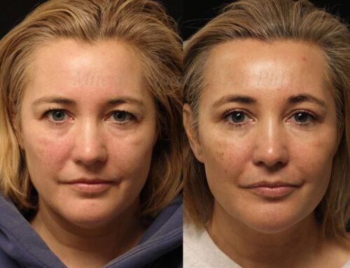 Before and 6 months after upper blepharoplasty surgery