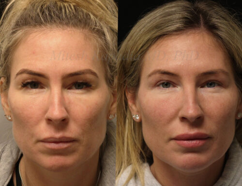 Before and 6 months after upper blepharoplasty surgery