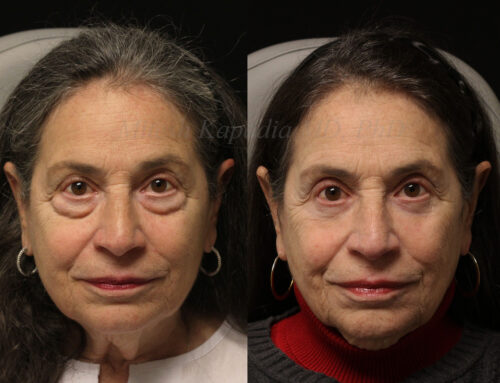 Before and 6 months after lower blepharoplasty surgery with lower lid CO2 laser resurfacing