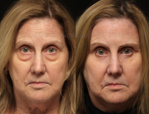 Before and 6 months after lower blepharoplasty surgery with lower lid CO2 laser resurfacing