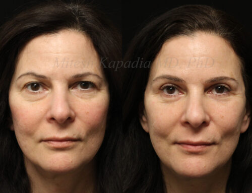 Before and 6 months after upper and lower blepharoplasty surgery with lower lid CO2 laser resurfacing