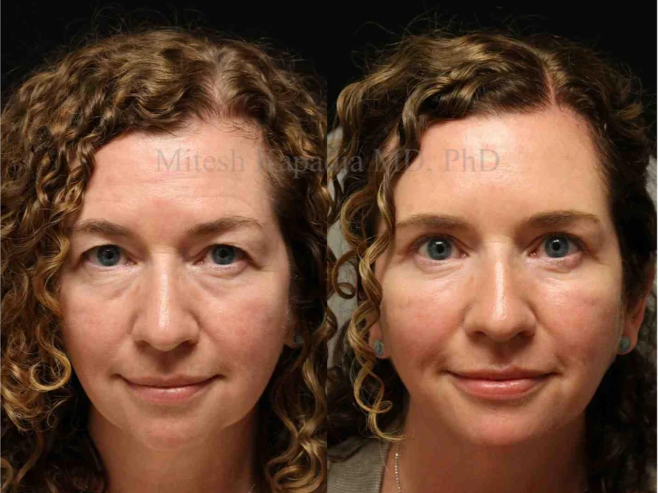 Before and after eyelid surgery results showing improved upper eyelid contour and reduced under eye puffiness by a Boston eyelid plastic surgeon.