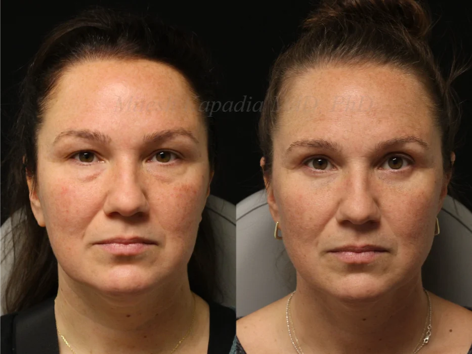 Before and after lower eyelid surgery showing reduction of under eye bags and smoother, firmer skin for a refreshed appearance in Boston MA.