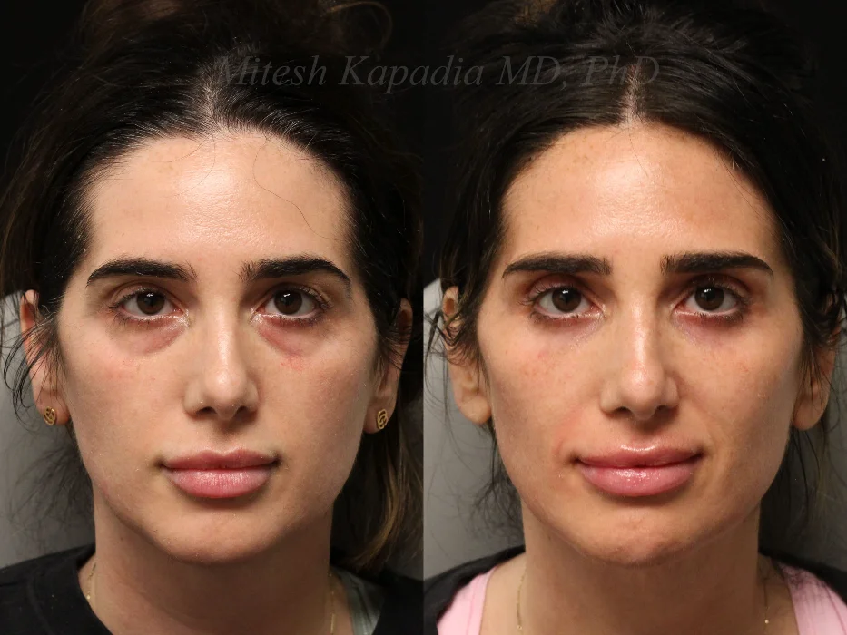 Lower blepharoplasty before and after photos demonstrating improvement in under eye puffiness and dark circles with natural looking results in Boston.