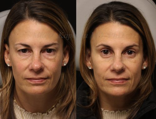 Before and 6 months after upper and lower blepharoplasty surgery