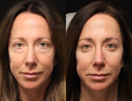 Before and 6 months after lower blepharoplasty surgery with lower lid CO2 laser resurfacing