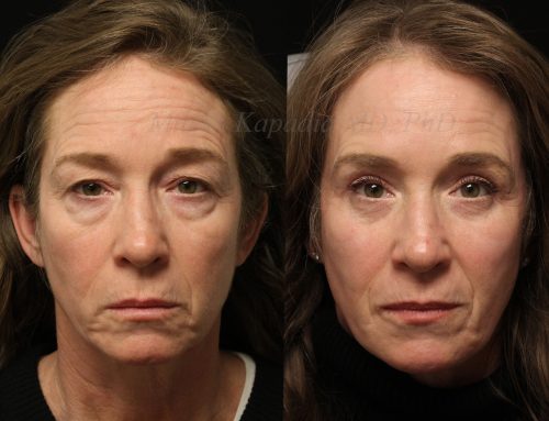 Before and 6 months after upper and lower blepharoplasty surgery with full face CO2 laser resurfacing