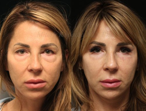Before and 7 months after upper and lower blepharoplasty surgery with lower lid CO2 laser resurfacing