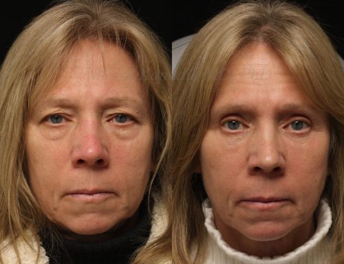 Before and 9 months after upper and lower blepharoplasty surgery with lower lid CO2 laser resurfacing