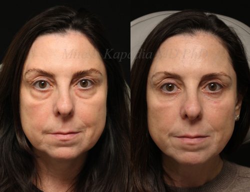 Before and 6 months after lower blepharoplasty surgery with lower lid CO2 laser resurfacing