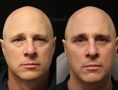 Before and 6 months after upper and lower blepharoplasty surgery with a direct brow lift