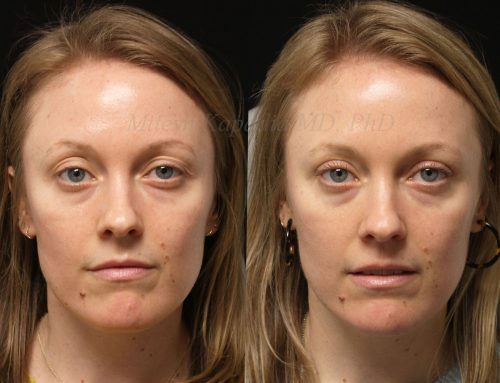 Before and 6 months after upper blepharoplasty surgery