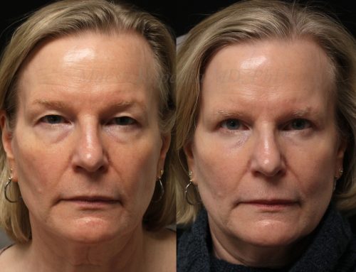 Before and 6 months after upper and lower blepharoplasty surgery with lower lid CO2 laser resurfacing