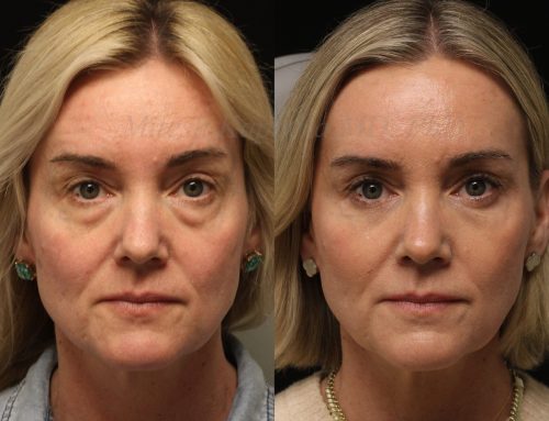 Before and 9 months after Lower blepharoplasty surgery with lower lid CO2 laser resurfacing