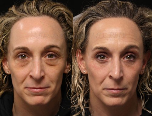 Before and 9 months after lower blepharoplasty surgery with lower lid CO2 laser resurfacing