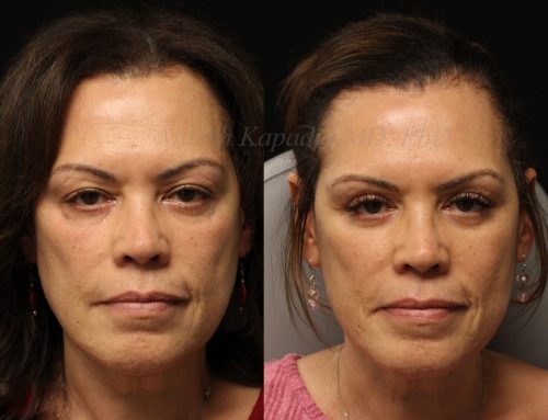Before and 10 months after upper and lower blepharoplasty surgery