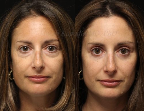 Before and 6 months after lower blepharoplasty surgery