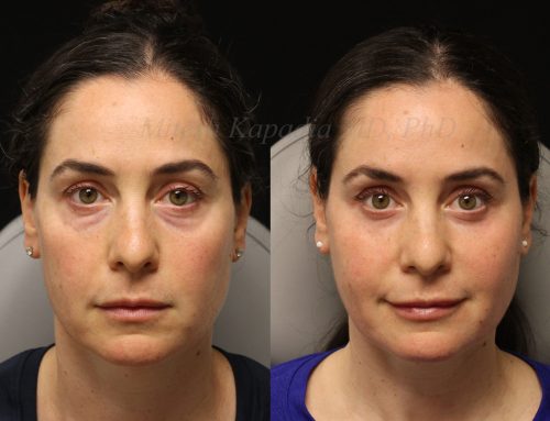 Before and 6 months after lower blepharoplasty surgery with lower lid CO2 laser resurfacing